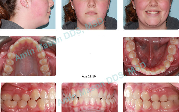 before traditional braces