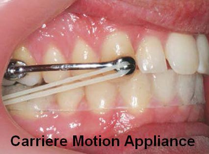 carriere motion appliance