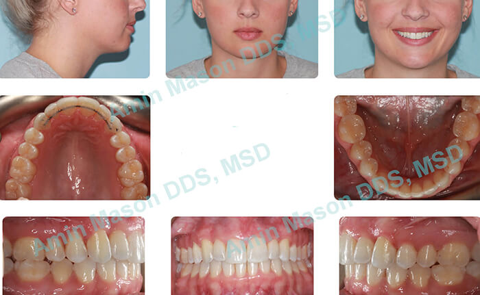 invisalign after case 2