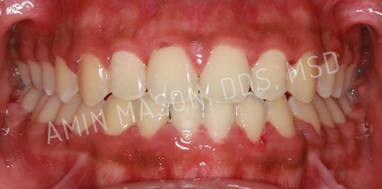 braces case 6 after