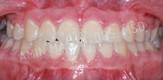 braces case 8 after