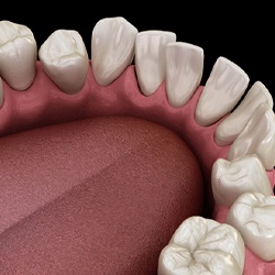 Illustration of misaligned teeth, may benefit from Invisalign treatment