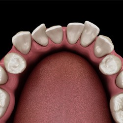 Top-view illustration of teen that could benefit from Invisalign