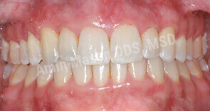 invisalign case 2 after