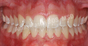 invisalign case 4 after