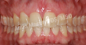 invisalign case 8 after