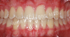 invisalign case 9 after