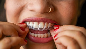 Close-up of woman placing Invisalign on her teeth