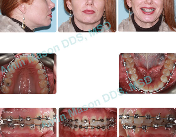 during full case braces