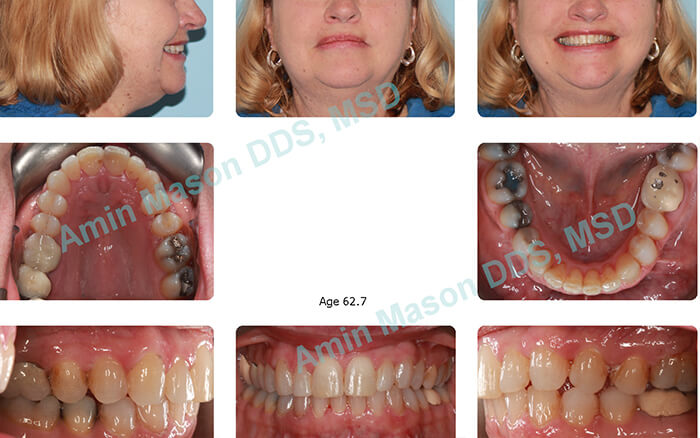 When to Start Adult Orthodontic Treatment