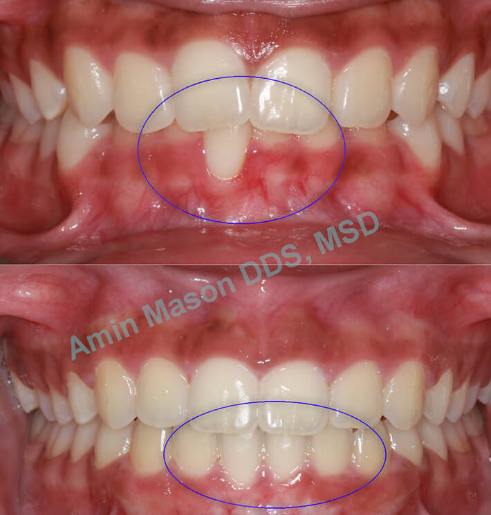 AOO gums before