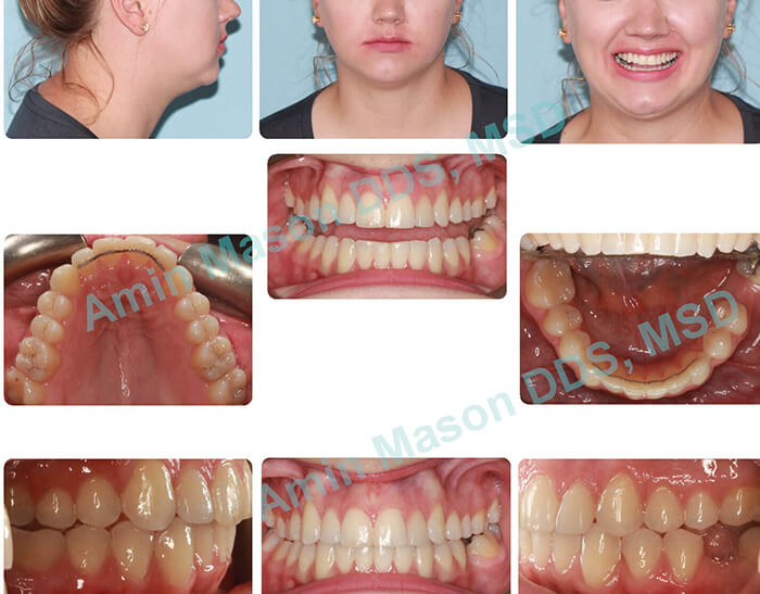 invisalign after