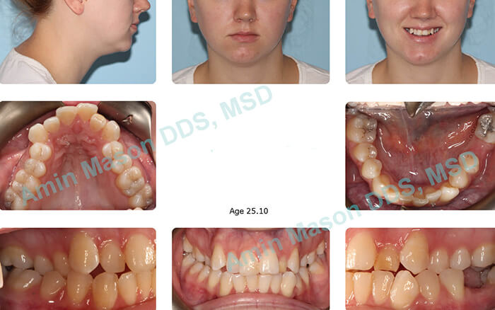 Invisalign Orthodontics, Columbus Clear Braces