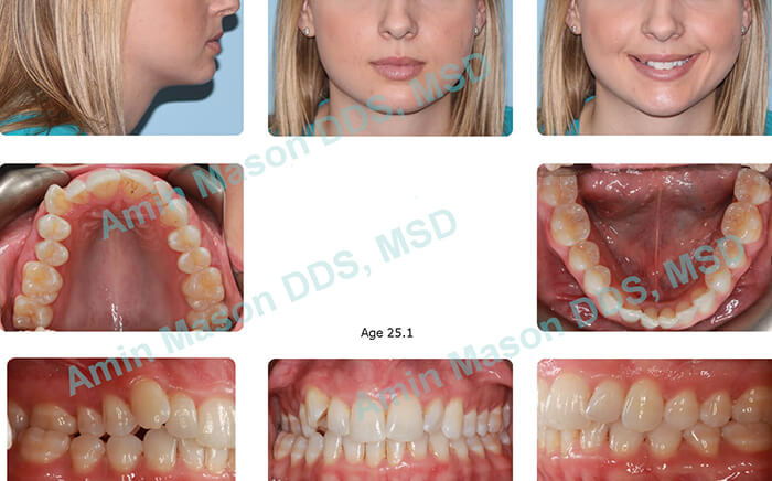 invisalign before case 2