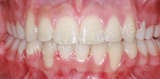 braces case 9 after