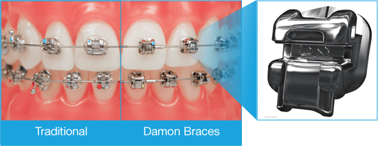 damon braces