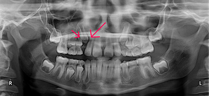 x-ray before