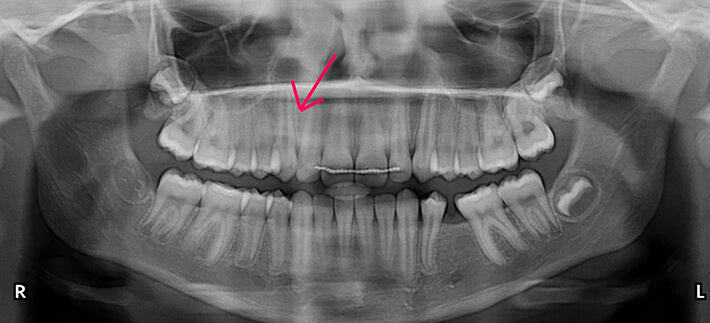 x-ray after