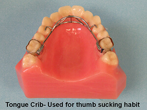 tongue crib appliance