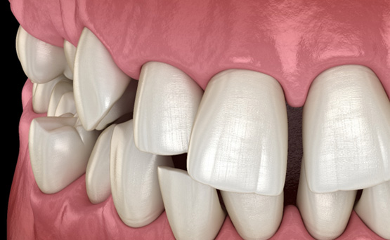 Close-up illustration of a crossbite