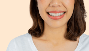 Woman’s smile with clear aligners on teeth