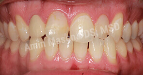 invisalign case 10 before
