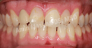 invisalign case 10 before