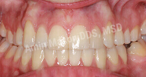invisalign case 1 after