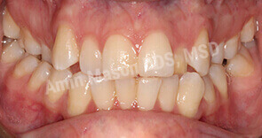 invisalign case 1 before