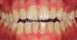 invisalign case 3 before