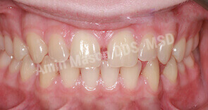 invisalign case 5 before