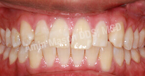 invisalign case 6 before