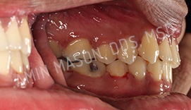 Sideways close up of a mouth with more closely aligned teeth