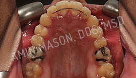 Lower row of newly straightened teeth