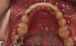 Close up of a row of straightened teeth