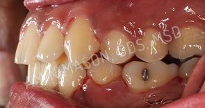 Sideways view of a mouth with evenly spaced teeth