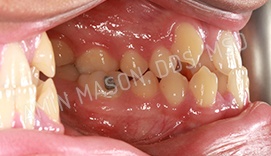 Sideways close up of a mouth with crowded teeth