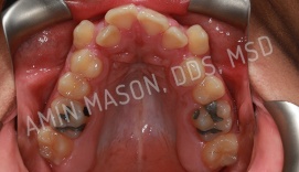Lower row of crooked and crowded teeth