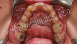 Close up of a row of crooked teeth