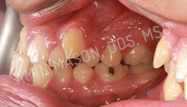 Sideways view of a mouth with crowded teeth
