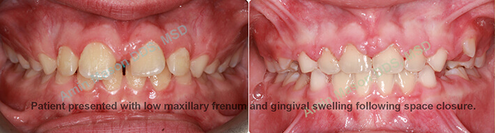 excess gingival swelling