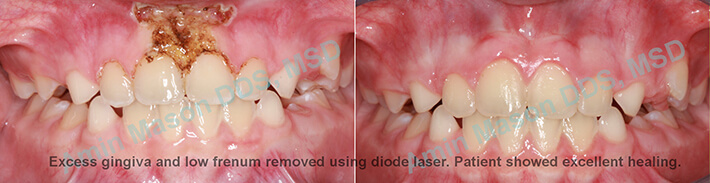 excess gingival removed