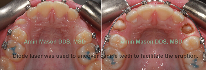 laser tooth exposure