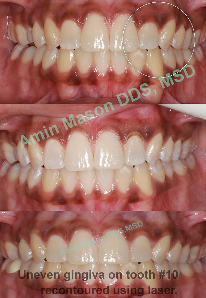 uneven gingiva recontouring