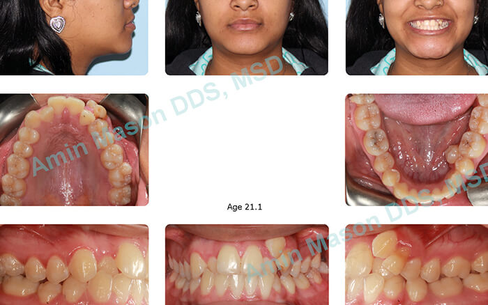 before self ligating braces