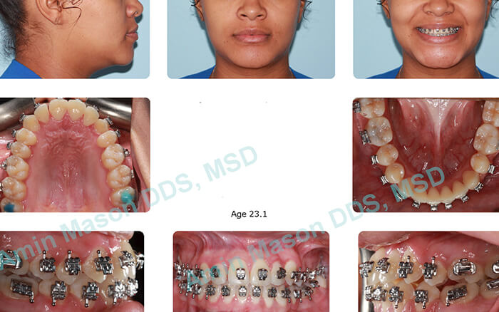 during self ligating braces