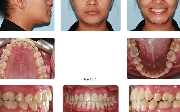 after self ligating braces