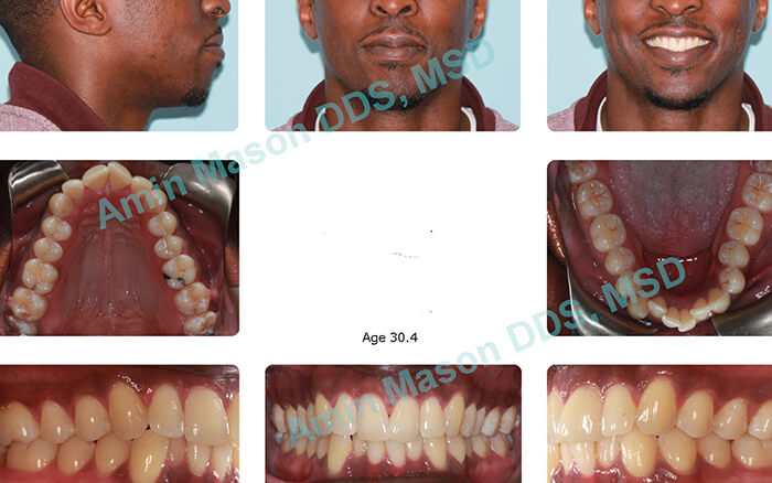 https://www.polarisorthodonticcenter.com/assets/images/lingualcase1a.jpg