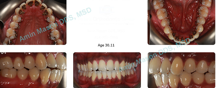 lingual case during