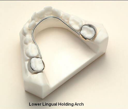 Lower Lingual Holding Arch